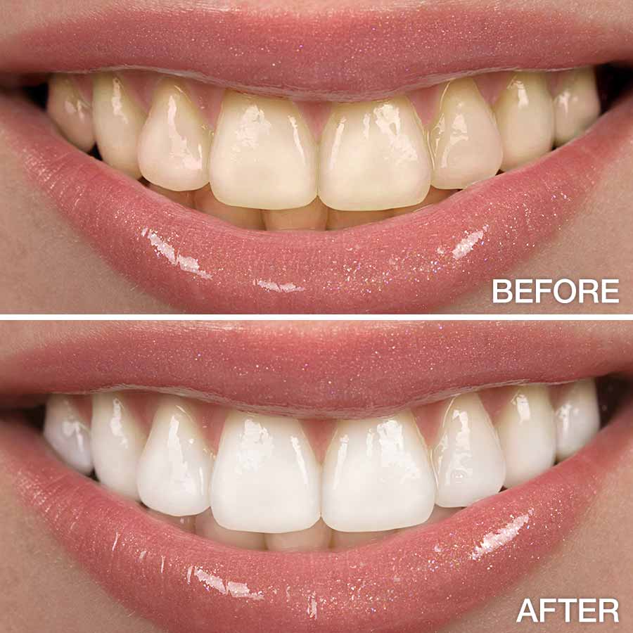 Teeth Whitening Before & After